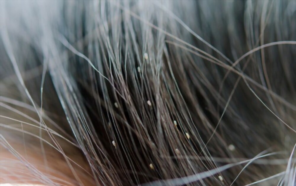 如何在家治疗头虱和头虱卵,以防止孩子头皮瘙痒