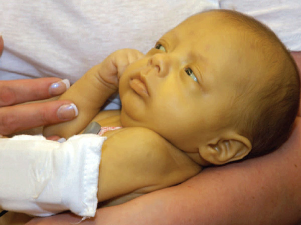 新生儿眼睛发黄-小心乙型肝炎