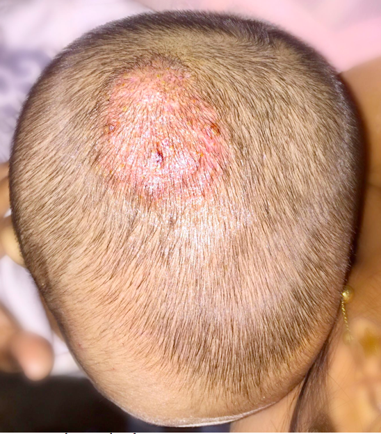 儿童癣 (体癣) 症状及治疗方法