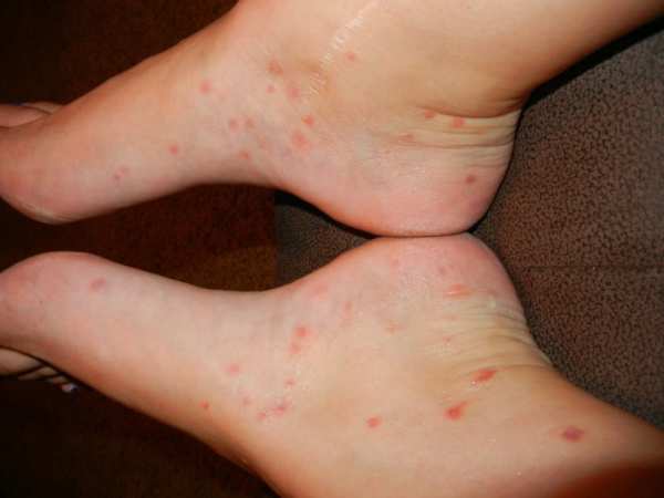 如何根据民间疗法有效治疗疥疮