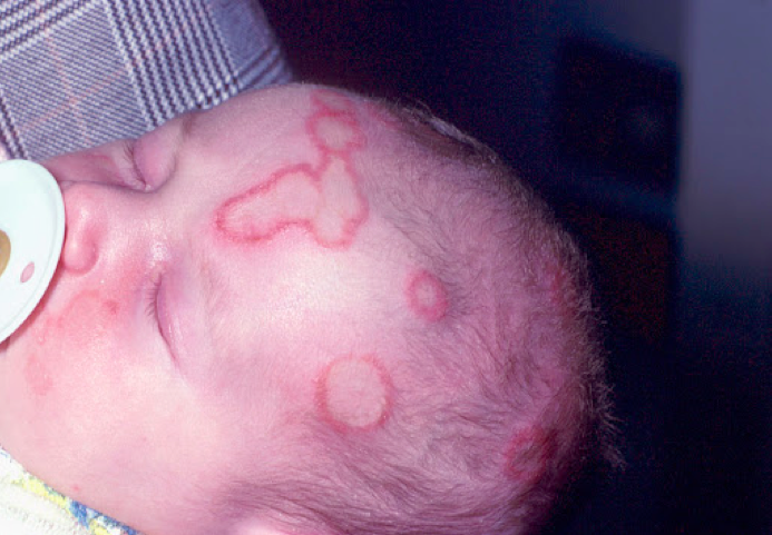 儿童癣 (体癣) 症状及治疗方法