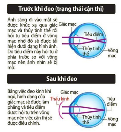 新的屈光不正儿童如何治疗非手术近视