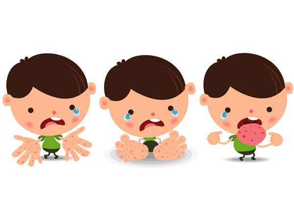 儿童手足口病: 婴儿的体征,治疗和预防