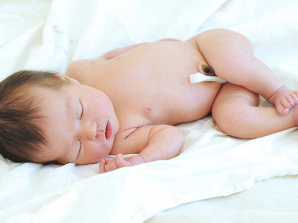 新生儿肚脐出血令人担忧