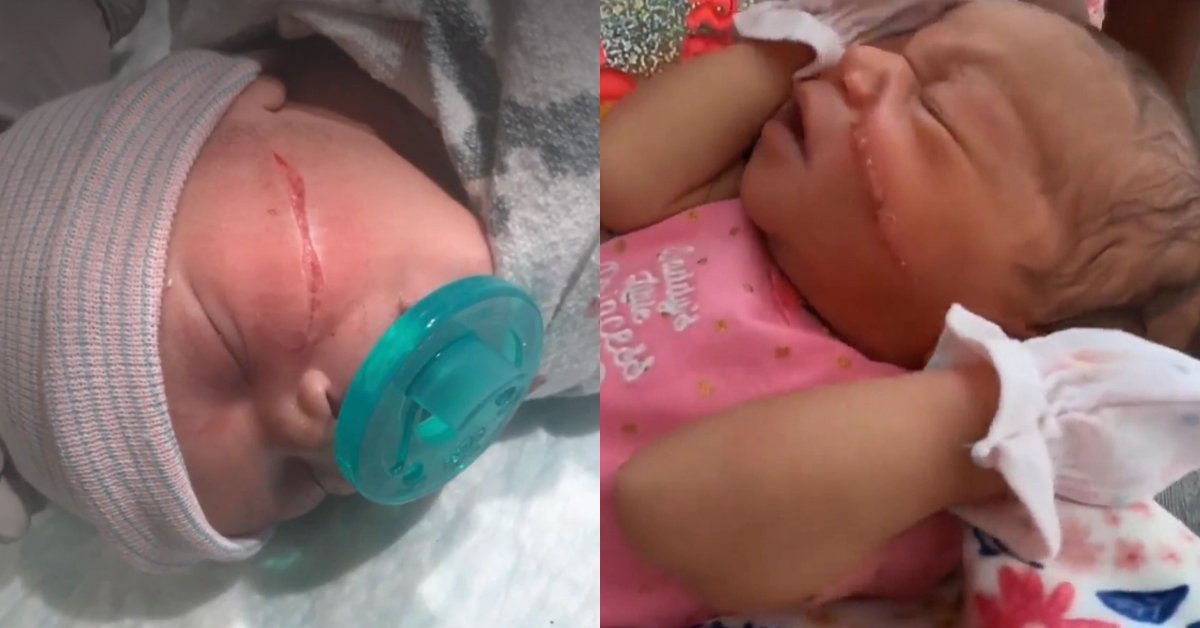 紧急剖腹产，划伤女婴左脸，缝13针令人心疼