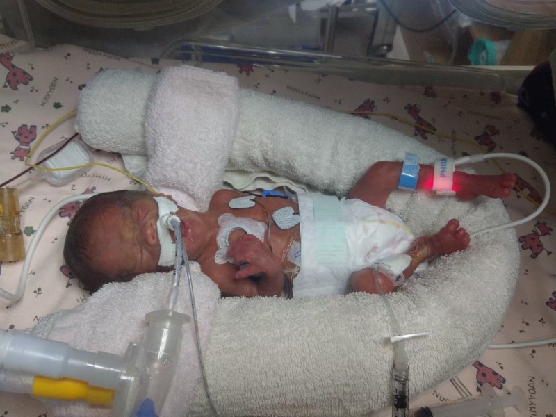 早产宝宝1岁了，出生仅590克，医师：我想看到孩子和妈妈脸上都露出笑容！