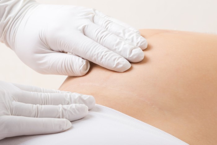 这一次剖腹产做好预防沾黏．让下一次生产更顺利