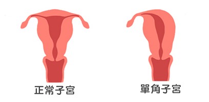 女星罹单角子宫，经两次试管成功生下宝宝！什么是单角子宫？