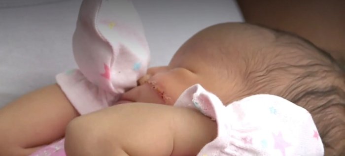 紧急剖腹产，划伤女婴左脸，缝13针令人心疼