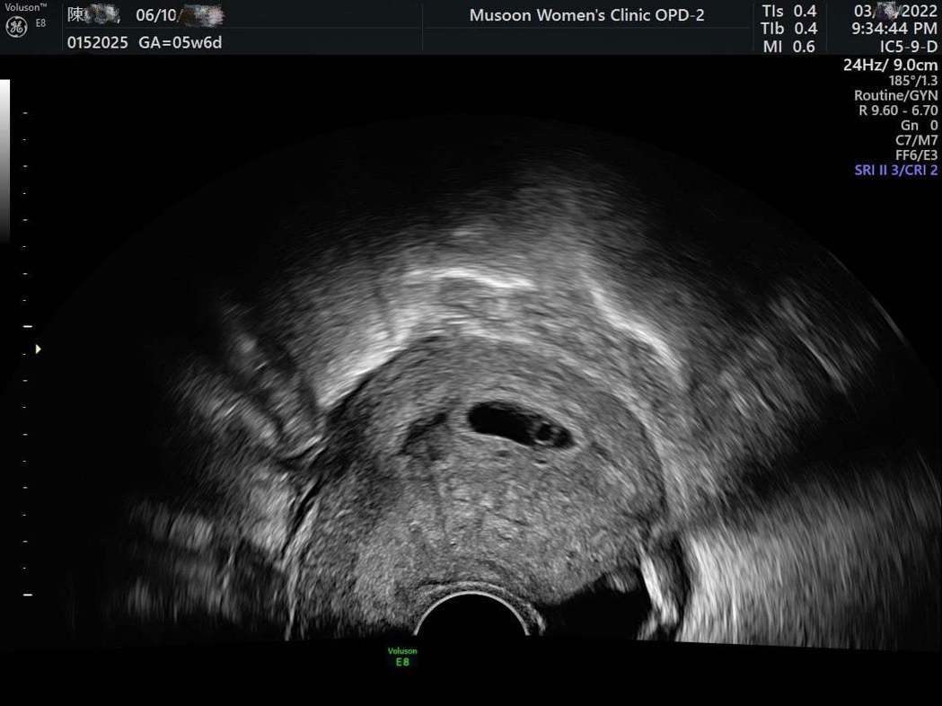 4个月前才流产茶花女莉娅晒超音波证实怀孕「谢摇滚回到我们身边」
