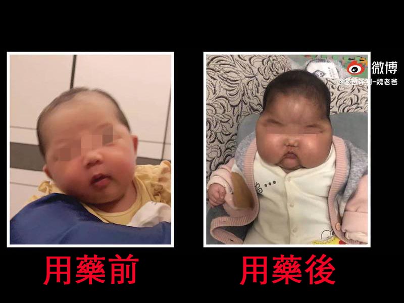 5月大的女婴脸肿两倍大、全身长毛、体重爆增！