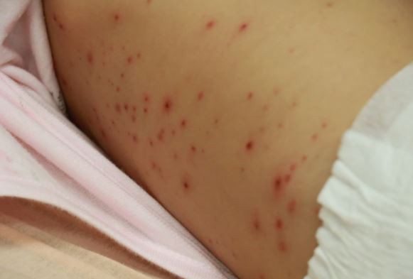 未满1岁女婴全身狂冒水痘、高烧不退母也中奖，罪魁祸首竟是爸爸长皮蛇