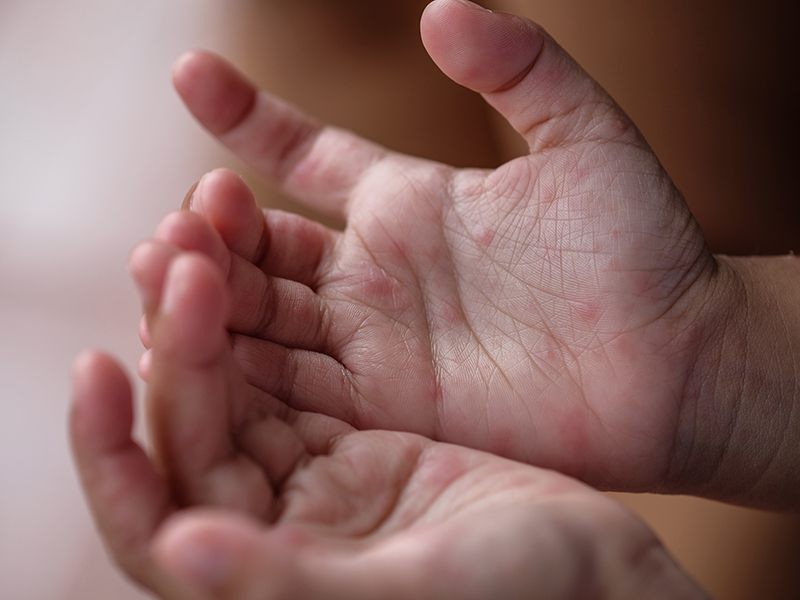 以为大人不会得肠病毒？父照顾肠病毒女儿，没洗手抽烟竟也染上肠病毒！