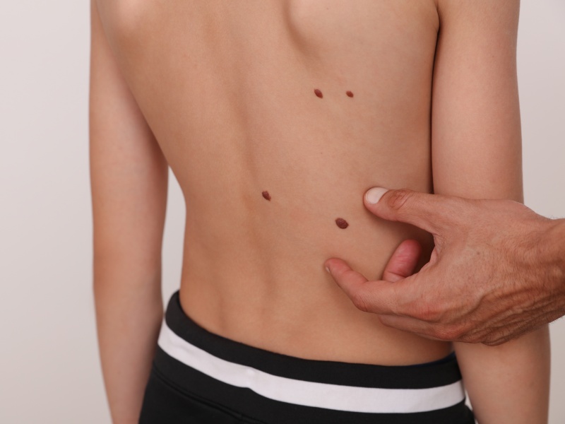 5岁男童身长咖啡色斑点险丧命，患「神经纤维瘤病」恐侵蚀神经、压迫气管、