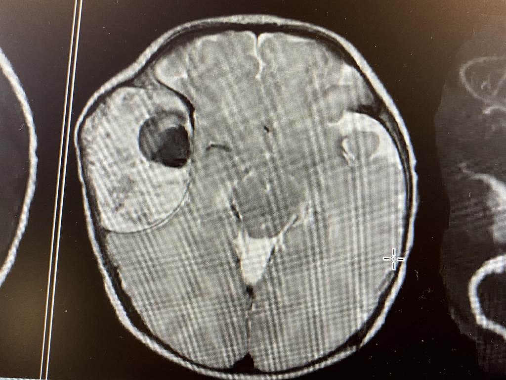 2月大男婴无端「狂吐哭闹」竟被诊断患「婴儿血管瘤」！