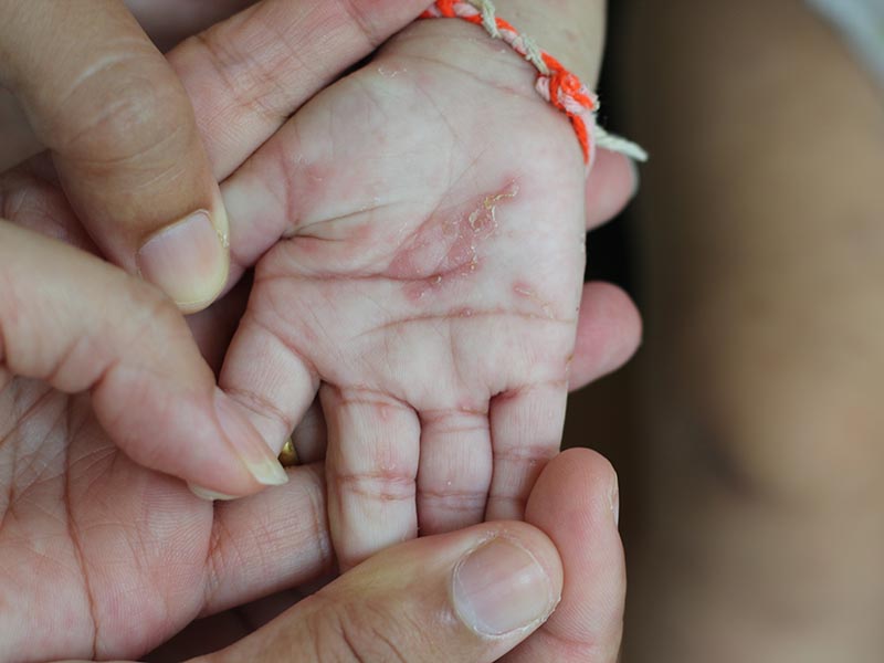 全身痒不代表是过敏1岁童指缝惊见虫穴道，是一人感染全家病的「疥疮」