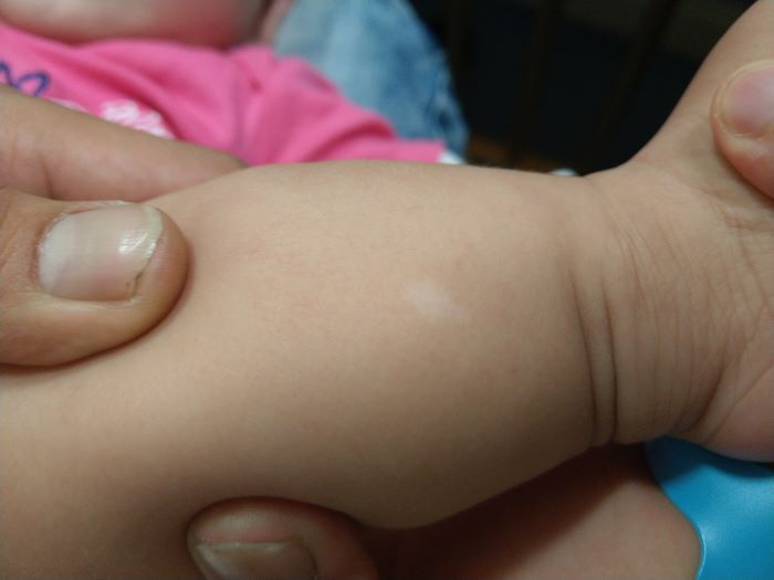 认识神经皮肤症候群．结节性硬化症，症状表现多样化诊断不易