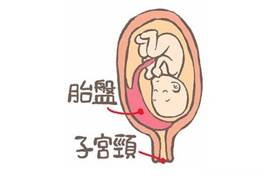 胎盘早剥危害大,预防胎盘早剥有这四点