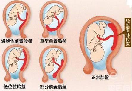 胎盘后壁生男生女靠谱吗？胎盘前置和胎盘后壁是什么意思？
