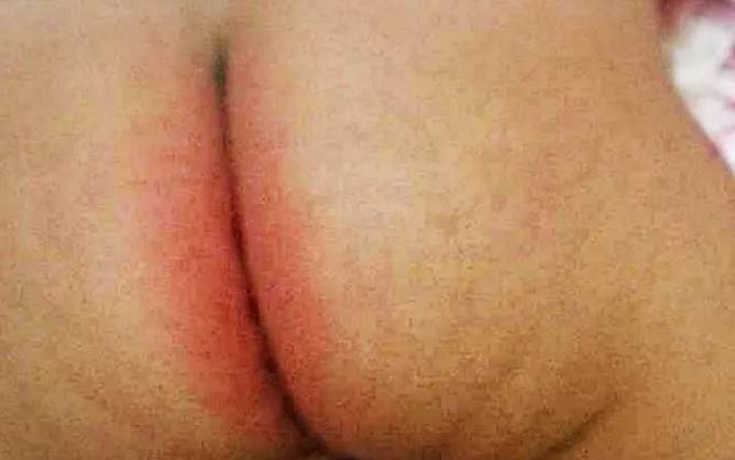 预防尿布疹，妈妈们如何避开这些婴儿臀部护理误区！