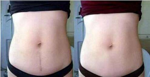 孕期怎么预防妊娠纹