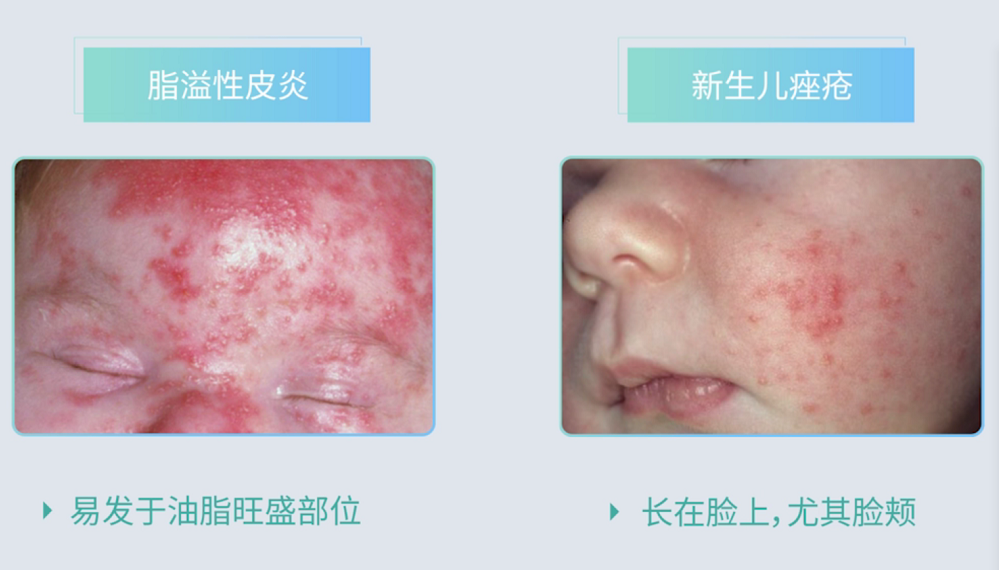 宝宝身上的疹子到底是啥？婴儿痤疮、脂溢性皮炎和湿疹有啥区别？