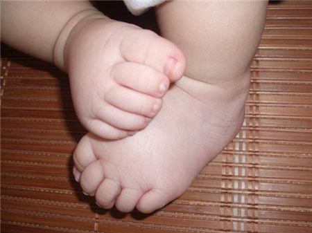 【足月儿黄疸】足月儿黄疸什么时候消退_足月儿黄疸多少为正常值