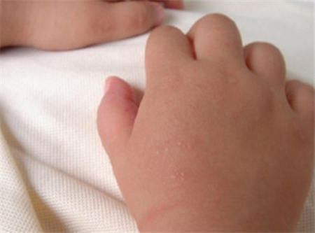 【宝宝长痱子】宝宝长痱子是什么原因_宝宝长痱子怎么办