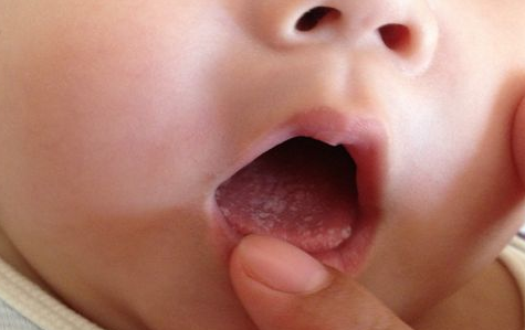 【宝宝舌苔发白怎么办】_宝宝舌苔厚白怎么处理_宝宝舌头上有白苔怎么办