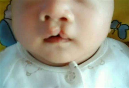 【兔唇】兔唇是怎么形成的_兔唇能完全修复吗