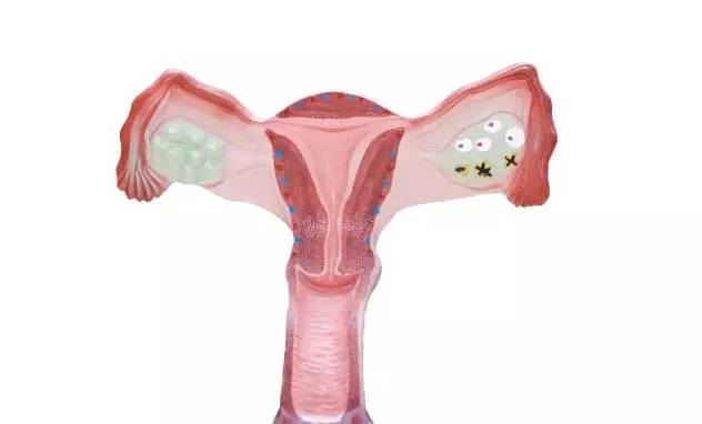 【宫颈糜烂】宫颈糜烂的症状_宫颈糜烂的原因