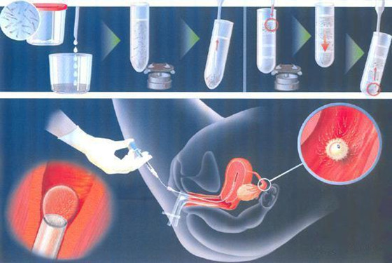 人工辅助受孕的全过程 100%你没见过的受孕过程