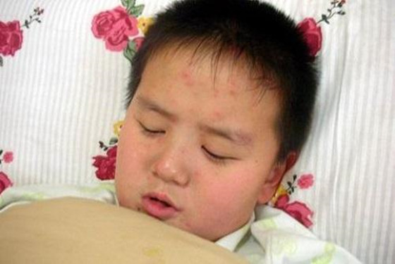【水痘】一张图带你了解水痘刚开始的样子图片