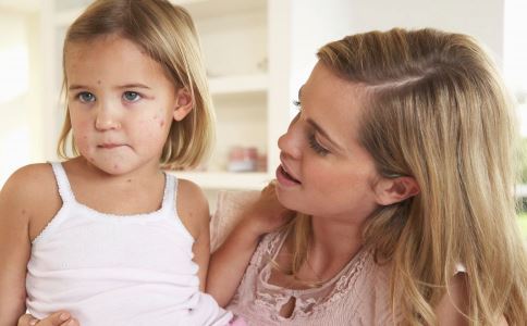 春季水痘高发 孩子如何远离水痘