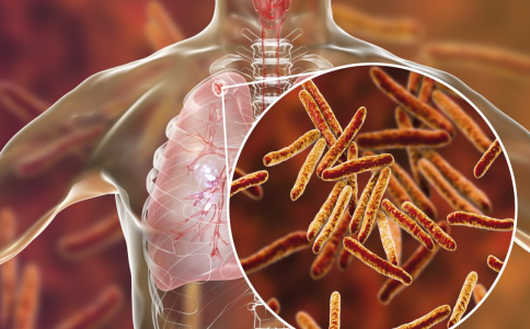 结核菌早发现早治疗很重要 结核病是一种什么病