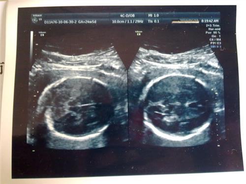 11周b超双顶径