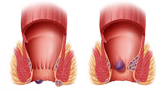 大便出血是什么原因