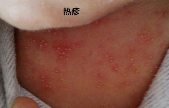 新生儿湿疹和热疹的区别在哪里 5张图片教你读懂