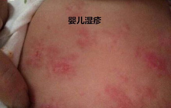 新生儿湿疹和热疹的区别在哪里 5张图片教你读懂