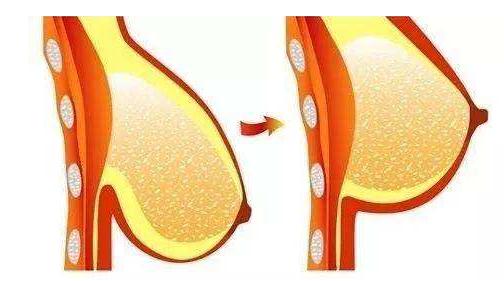 是不是大的胸容易下垂：胸部下垂的原因及如何预防