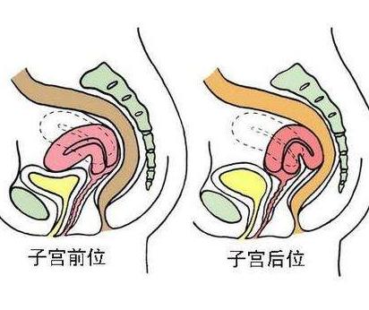 子宫后位是什么意思：子宫前位好还是后位好