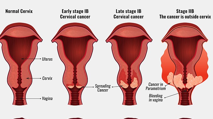 子宫内膜癌严重吗