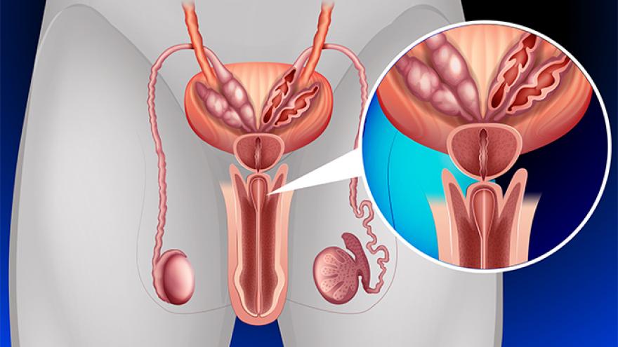 什么是慢性前列腺炎