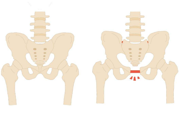 顺产会造成阴道松弛吗？产后阴道松弛可以恢复吗？