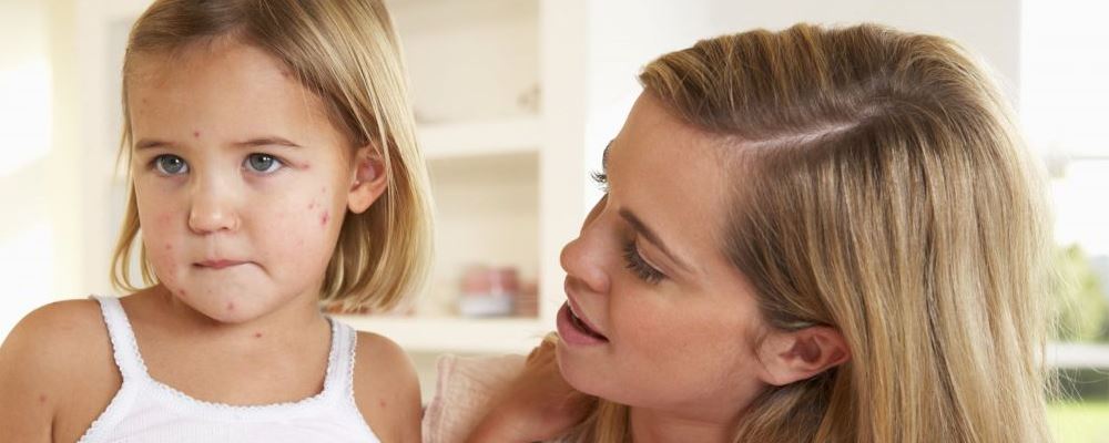 怎么辨别宝宝是否出水痘 水痘如何治疗