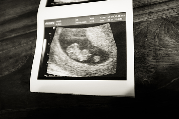 hcg翻倍正常孕酮下降 先别急着担心看完后再说