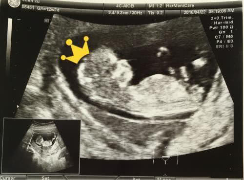 孕妈妈如何通过四维彩超对比图辨别胎儿性别