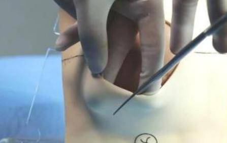 顺产侧切是什么意思 顺产的孕妈侧切是必须的吗?