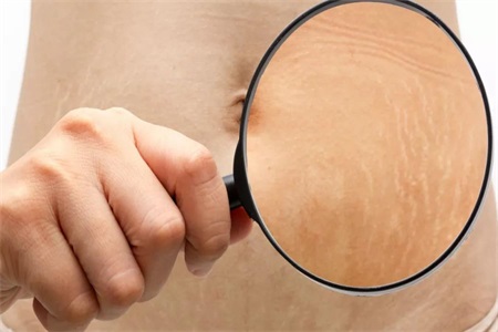 怀孕如何防止长妊娠纹