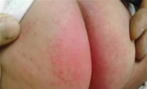 红屁屁又来了？宝宝尿布疹重在预防